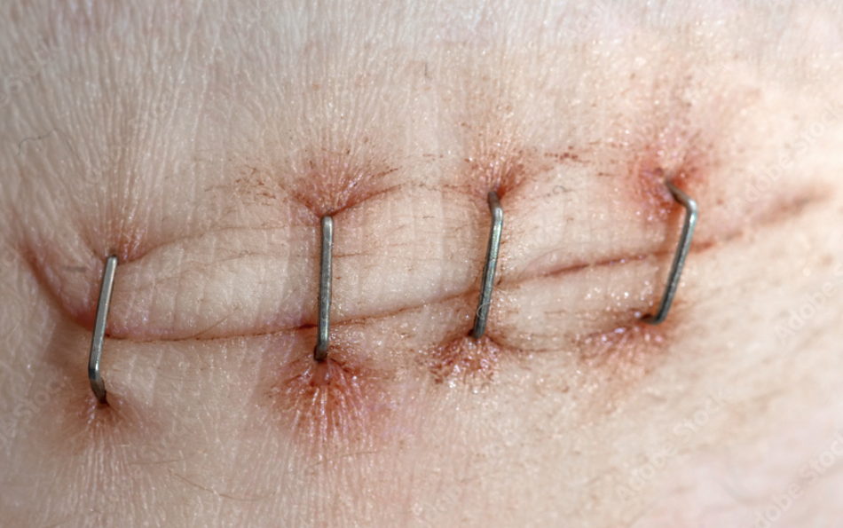 Tissue Adhesives, Surgical Staples